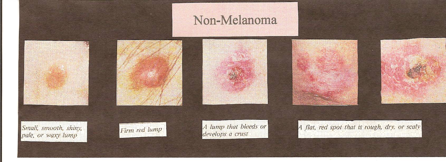 Pictures designed to show types of non melanomas